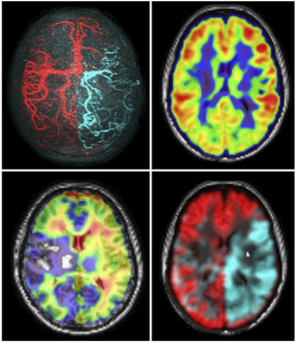 Quantitative Hemodynamic Imaging in Cerebrovascular Diseases .png, 17 kB