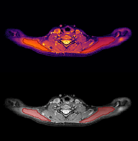 Quantitative Imaging and Neuromodulation in Migraine .png, 17 kB