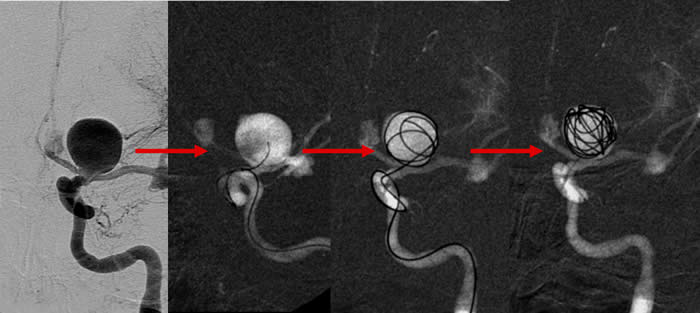 Aneurysma